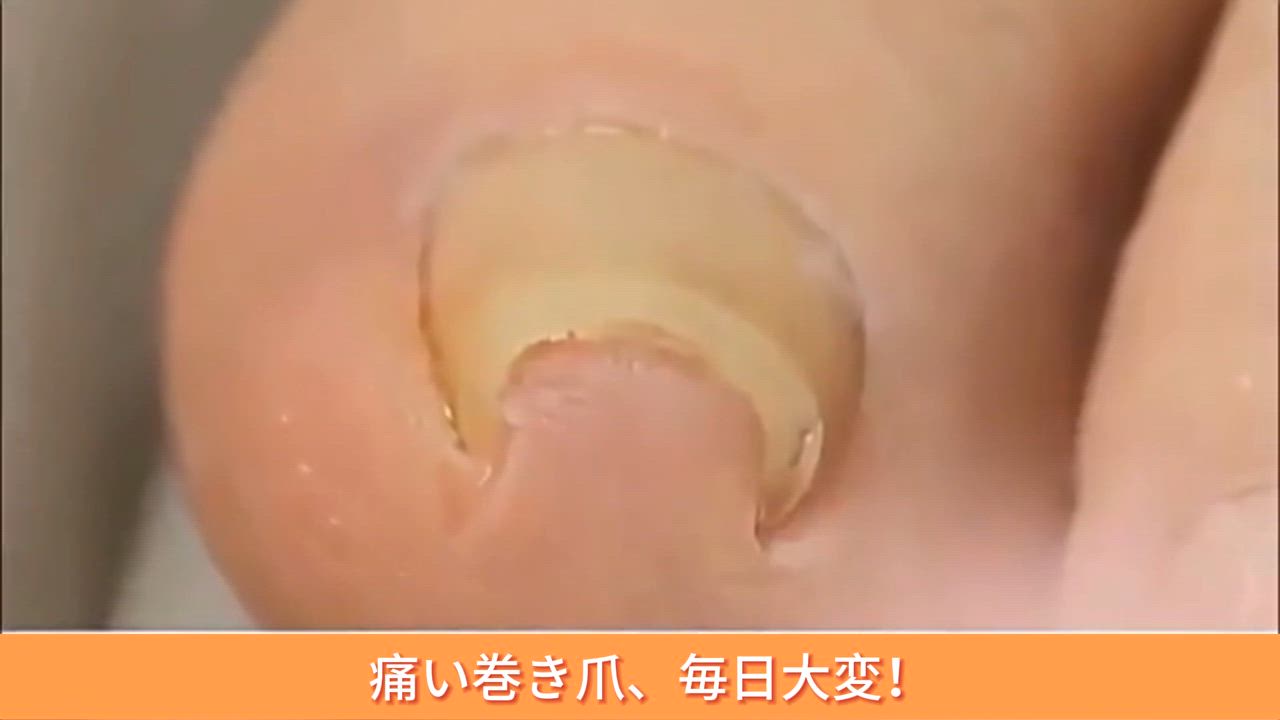 【雑誌掲載】巻き爪矯正 セット 自分で 20分だけ 治療 爪切り 巻き爪クリップ ワイヤー ネイルエイド 陥入爪 巻き爪 ネイル 矯正グッズ 自宅で矯正 補正 |  | 13